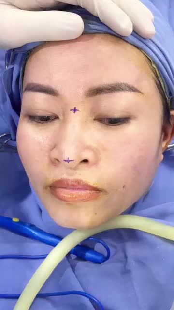 Mũi vẹo lệch - sống mũi thấp tẹt cải thiện thế nào?
