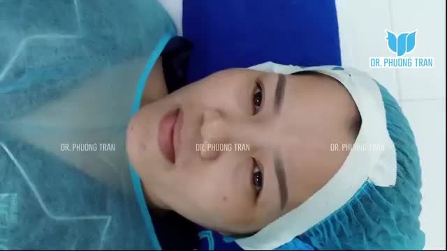 NÂNG MŨI CẤU TRÚC KẾT HỢP CẮT MÍ MẮT TRÊN
