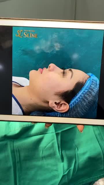 NÂNG TẦM NHAN SẮC VỚI PHƯƠNG PHÁP NÂNG MŨI CẤU TRÚC SOFTXIL