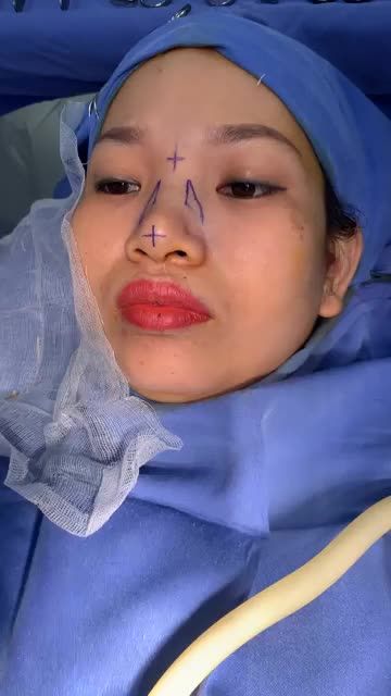 Phân tích nâng mũi cấu trúc 4D Bấm xem ngay