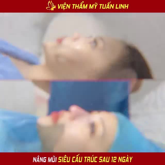 CLIP REVIEW NÂNG MŨI SAU 12 NGÀY... NGAY BÊN DƯỚI