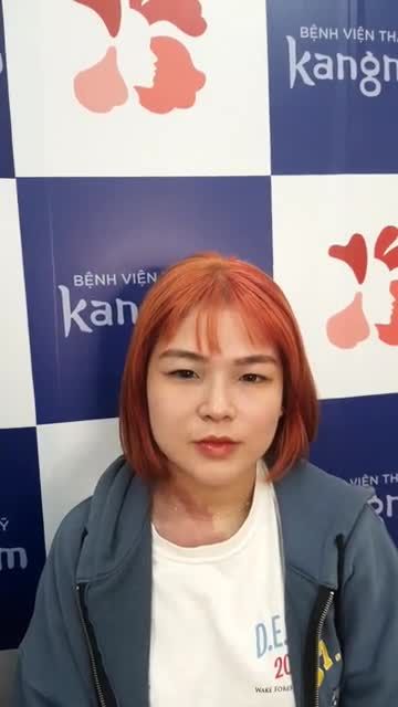 Khách hàng "siêu cá tính" tới Kangnam tái khám nâng mũi cấu trúc 4D sụn sườn Nanoform