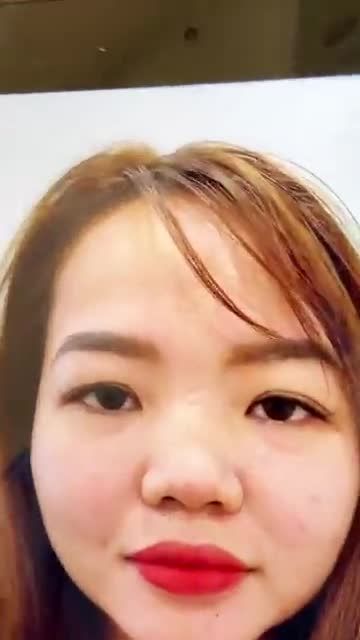 Mũi cao sang sau 90 phút nâng cấu trúc Surgiform
