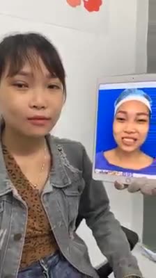 Tình trạng trước thẩm mỹ: Hàm móm, gãy do chấn thương vùng mặt, khớp cắn lệch