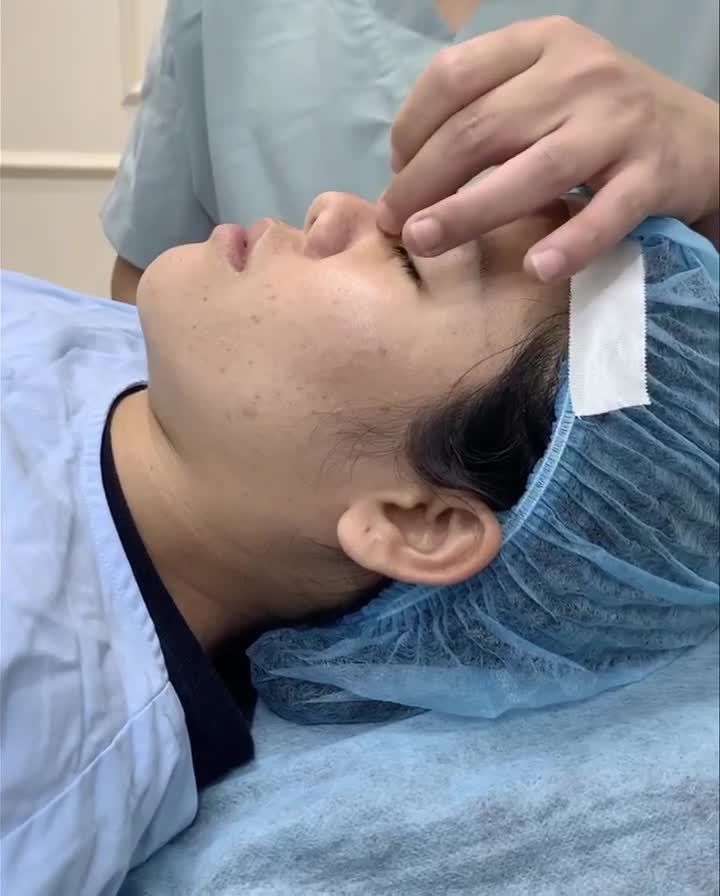 Trước mổ: Khách hàng nâng mũi 10 năm, hiện tại mũi hếch, đầu mũi chưa bay