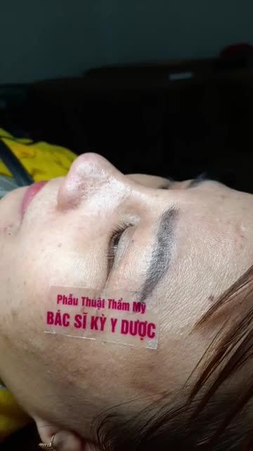 Tái khám sau 10 ngày Nâng mũi bán cấu trúc 2 lớp Kết hợp thu nhỏ đầu mũi và cuộn cánh mũi plasma