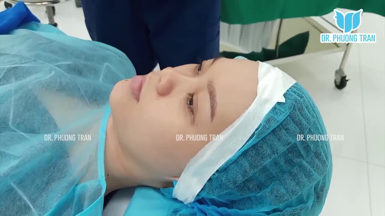CHUẨN BỊ NÂNG MŨI CHO BẠN NÀY: SỐNG MŨI THẤP, ĐẦU MŨI TO BÈ