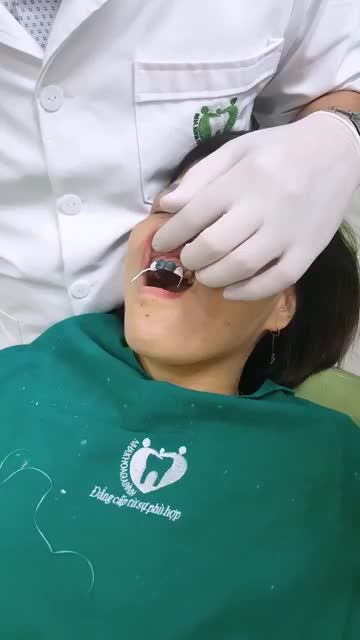 DÁN SỨ VENEER ĐỈNH CAO CỦA THẨM MỸ RĂNG