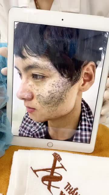 Khách hàng trị chàm bẩm sinh buổi 6, hiệu quả hơn cả sự mong đợi. Đặc biệt ưu đãi đến 50% dịch vụ trị chàm tại TMV Xuân Hương