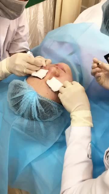 TẠM BIỆT SẸO LÕM, SẸO RỖ LÂU NĂM