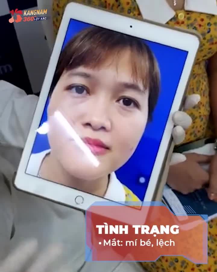 Nâng mũi + Cắt mí xong là cả khuôn mặt bừng sáng ngời ngời