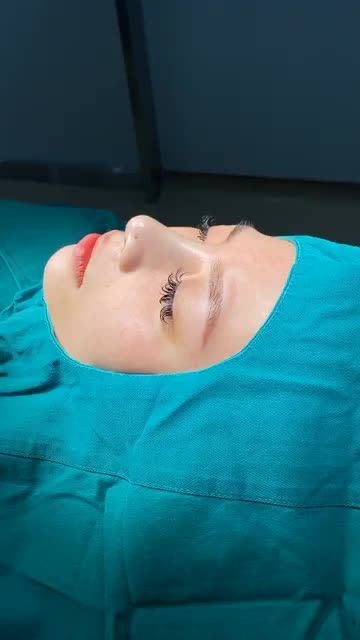 KẾT QUẢ CA NÂNG MŨI SLINE