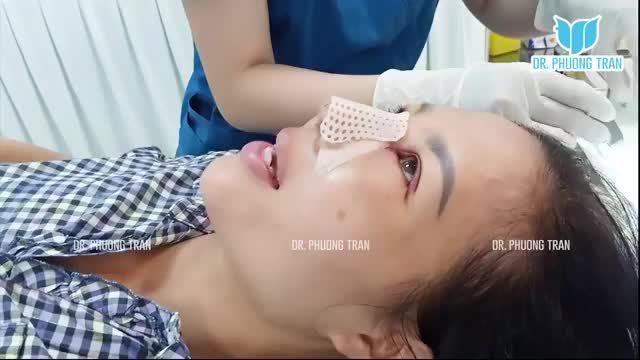 NGÀY ĐẦU TIÊN SAU NÂNG MŨI SỤN SƯỜN TOÀN PHẦN