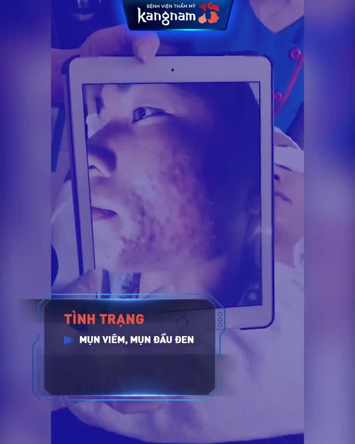 Hạnh phúc khi thoát MẶT MỤN KINH HOÀNG!