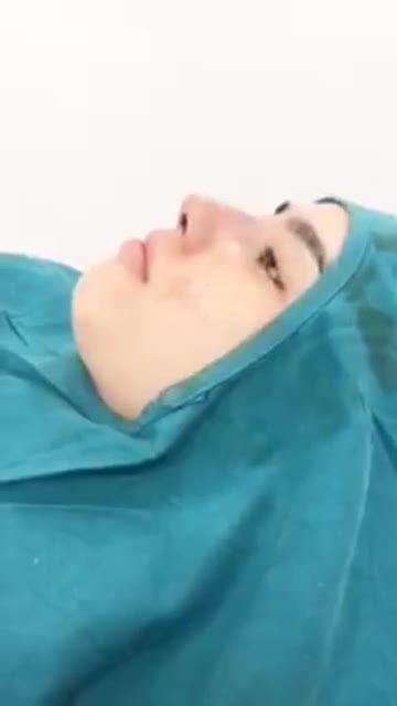 TÁI THẨM MỸ MŨI SAU TIÊM FILLER