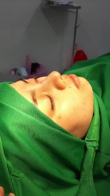 Nâng mũi bán cấu trúc 2 lớp