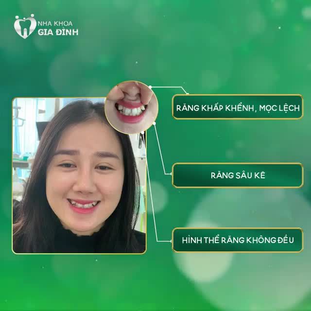 Chị Hồng Nhung trước khi đến với Nha khoa Gia Đình gặp phải tình trạng răng khấp khểnh khá nặng, răng lại nhiễm màu kháng sinh, sâu nhiều.