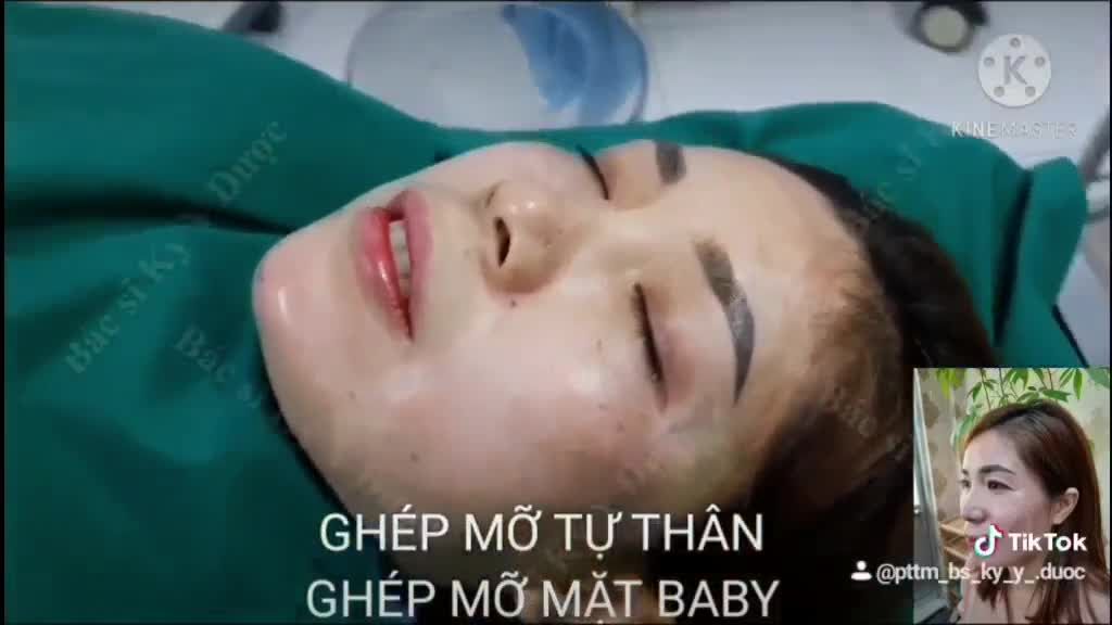 GHÉP MỠ TỰ THÂN , GHÉP MỠ MẶT BABY TẠI BS KỲ