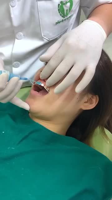 LIÊN TỤC CÓ NHỮNG CASE DÁN SỨ VENEER KHÔNG MÀI RĂNG