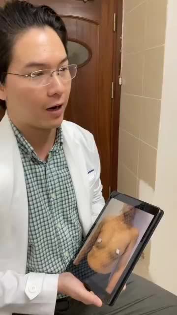 CHỊ KHÁCH HÀNG ĐẾN TỪ HƯNG YÊN ĐƯỢC ÔNG XÃ “HỘ TỐNG” TỚI TÁI KHÁM SAU 2 THÁNG NÂNG NGỰC