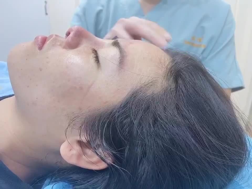 Kết quả sau mổ chỉnh lại mũi nâng bị hếch và lộ sống