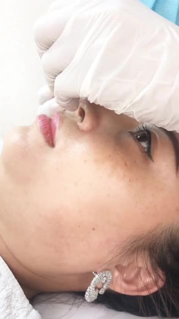 Khách hàng rút chỉ mũi sau 10 ngày
