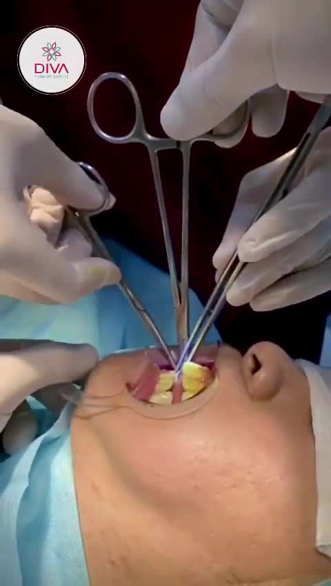 LẤY TÚI MỠ MÁ: MẶT GỌN, GIẢM CHẢY XỆ HIỆU QUẢ