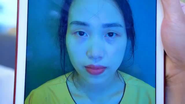 Mời quý khách hàng cùng theo dõi ca Cắt mí mk sau 7 ngày thực hiện và xem thử em gái trẻ trung xinh đẹp như thế nào nhé.!