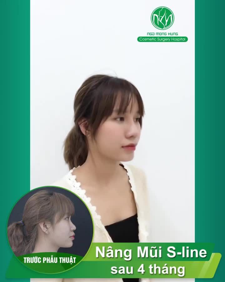 NÂNG MŨI SLINE CHO DÁNG MŨI CAO TÂY ĐẸP TỰ NHIÊN