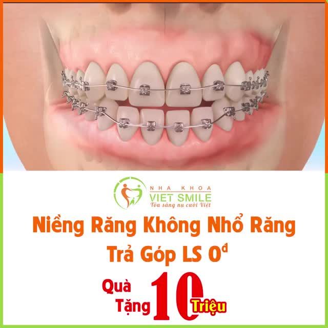 Niềng răng không nhổ răng – Trả góp lãi suất 0đ