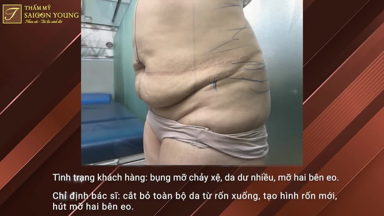 Tạo hình thành bụng chuyển rốn