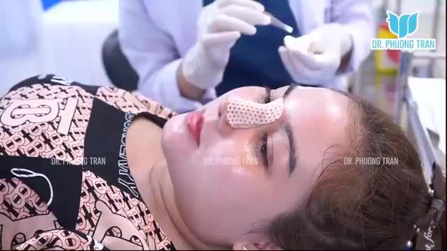 THÁO NẸP SAU 6 NGÀY NÂNG MŨI CẤU TRÚC