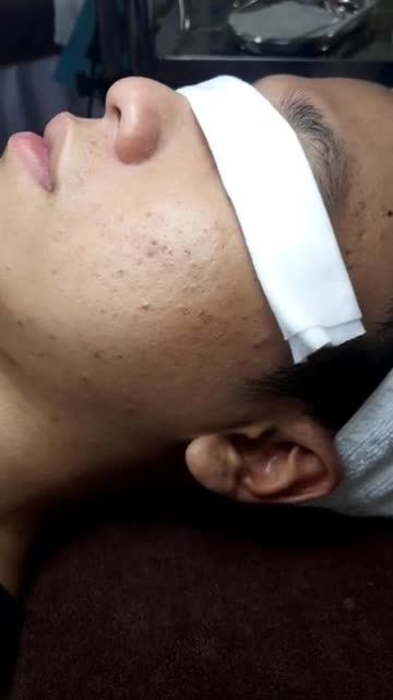 TRẦM TRỒ với ca lấy nhân mụn đầu đen của khách hàng nam