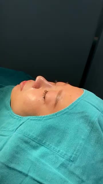 TỰ TIN VỚI DÁNG MŨI HOÀN HẢO NHỜ “NÂNG MŨI CẤU TRÚC SOFTXIL”