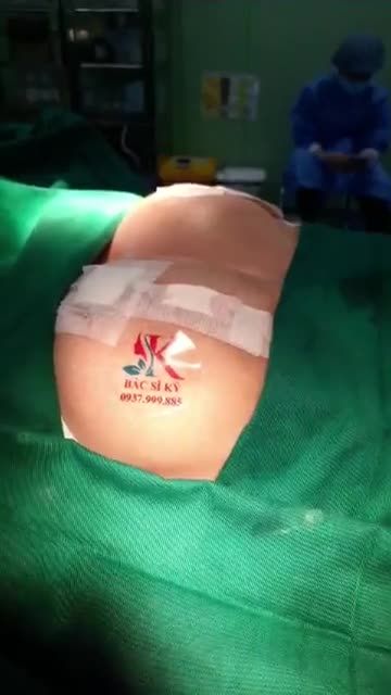 XỬ LÝ KHẮC PHỤC NGỰC PHÌ ĐẠI SA TRỄ ĐỘ 4 - QUẦNG NGỰC TO