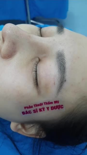 KHÁCH HÀNG TÁI KHÁM SAU 15 NGÀY NÂNG MŨI