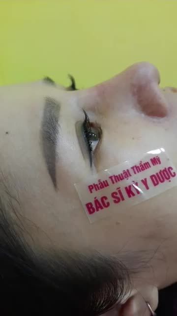 KHÁCH HÀNG TÁI KHÁM SAU GẦN 1 THÁNG NÂNG MŨI SỤN TAI