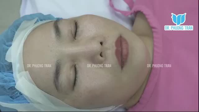 NÂNG MŨI SỤN SƯỜN KẾT HỢP CẮT MÍ MẮT TRÊN Bạn nào muốn biết combo này sẽ giúp thay đổi diện mạo như thế nào thì theo dõi nhé!