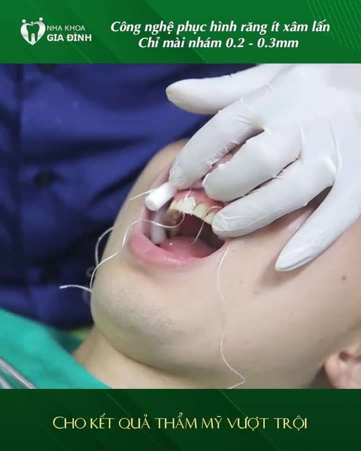 DÁN SỨ VENEER THẨM MỸ RĂNG ÍT XÂM LẤN