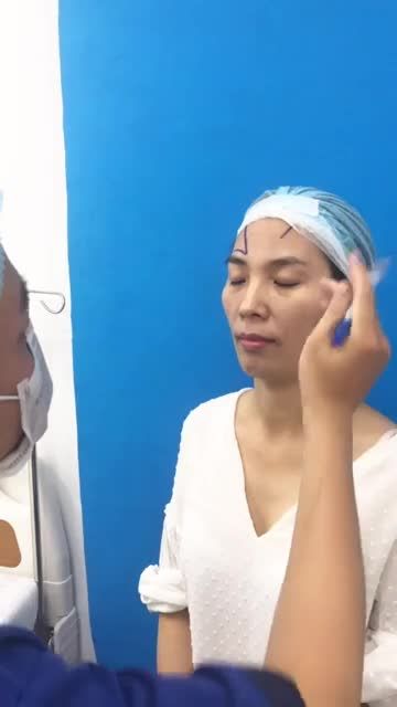 Cận cảnh quá trình đo vẽ trước lúc bước vào quá trình cấy mỡ toàn mặt