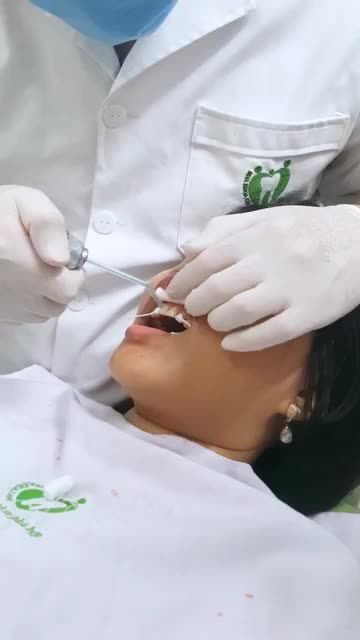 DÁN SỨ VENEER KỸ THUẬT PHỤC HÌNH AN TOÀN NHẤT HIỆN NAY