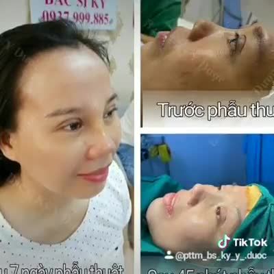 NÂNG MŨI THAY ĐỔI PHONG THỦY MANG ĐẾN DIỆN MẠO HOÀN TOÀN MỚI