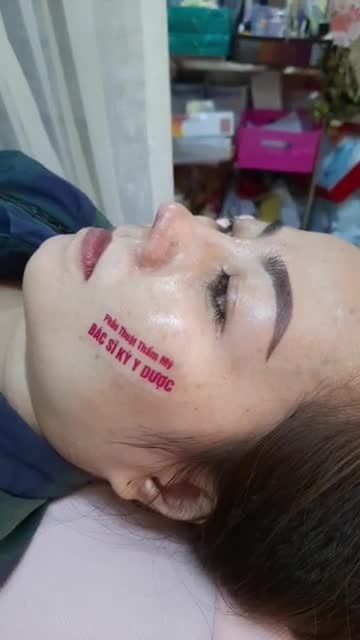 KHÁCH HÀNG TÁI KHÁM SAU 20 NGÀY PHẪU THUẬT​​​​​​​ Nâng mũi bán cấu trúc 2 lớp