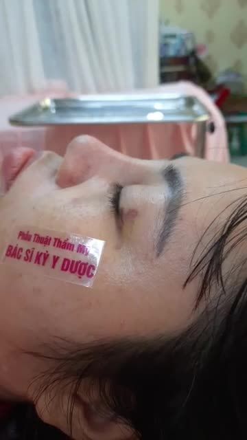 KHÁCH HÀNG TÁI KHÁM SAU 11 NGÀY PHẪU THUẬT NÂNG MŨI BÁN CẤU TRÚC SỤN TAI 2 LỚP
