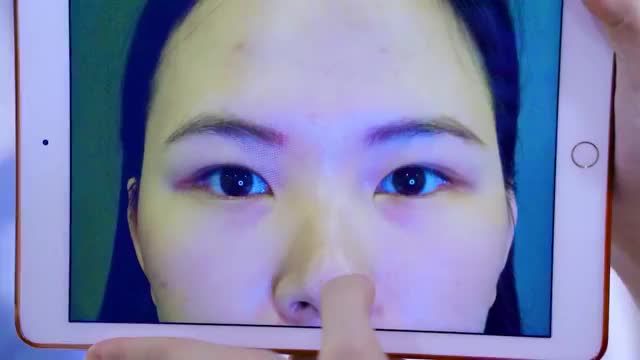 Chỉ sau 45 phút thực hiện tiểu phẫu Cắt mí khách hàng cảm nhận như thế nào? Mời khách hàng cùng theo dõi