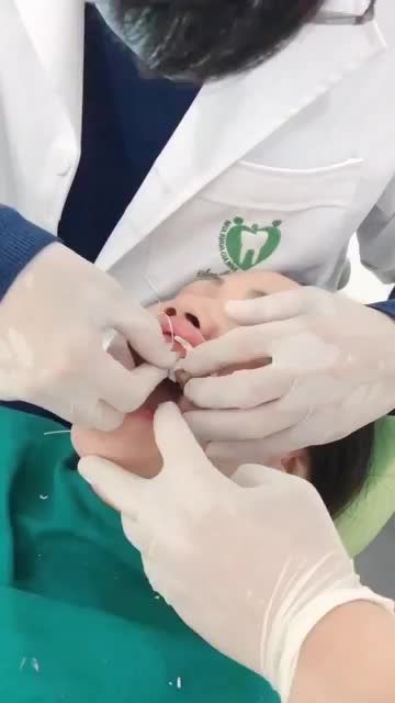 DÁN SỨ VENEER CHƯA BAO GIỜ HẾT HOT!!!