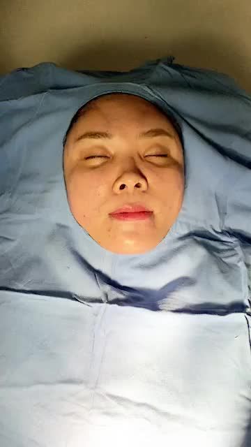 Kết quả sau 60p cấy mỡ mặt tại Bvtm đông á