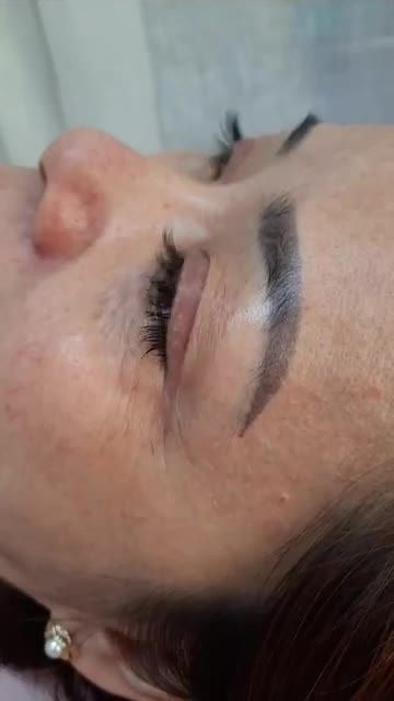 TÁI KHÁM SAU 1 NĂM CẮT MẮT MÍ TRÊN VÀ DƯỚI CHUẨN BỊ PHẪU THUẬT CUỘN CÁNH MŨI PLASMA