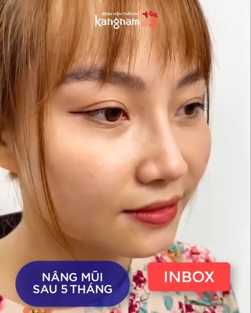 Cận cảnh dáng MŨI "NÉT NHƯ SO.NY" sau 5 tháng