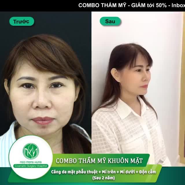 Căng da mặt phẫu thuật + cắt mí trên, dưới + độn cằm – combo hoàn hảo đánh bại các dấu hiệu lão hóa, lấy lại vẻ đẹp thời thanh xuân.